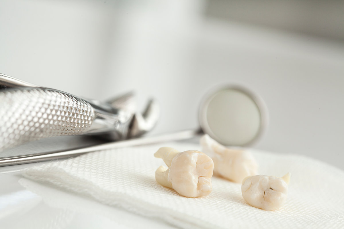 What Should I Expect During Wisdom Tooth Removal At Haratz Dental?