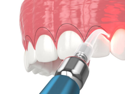 Upper jaw treated with laser for gummy smile. Creating a new gum line by gingivectomy.