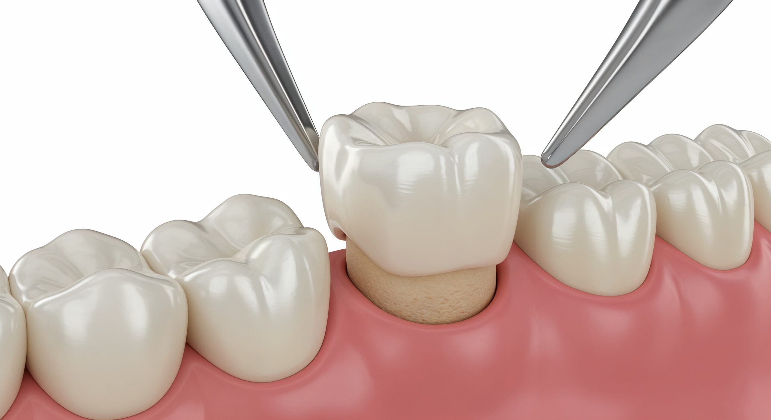 How Long Does It Take To Get A Dental Crown From Start To Finish?