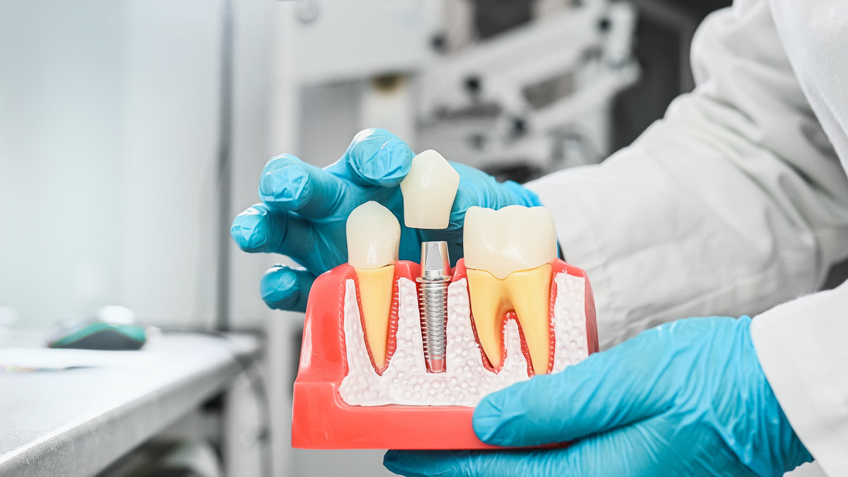 What To Expect During Dental Implant Recovery