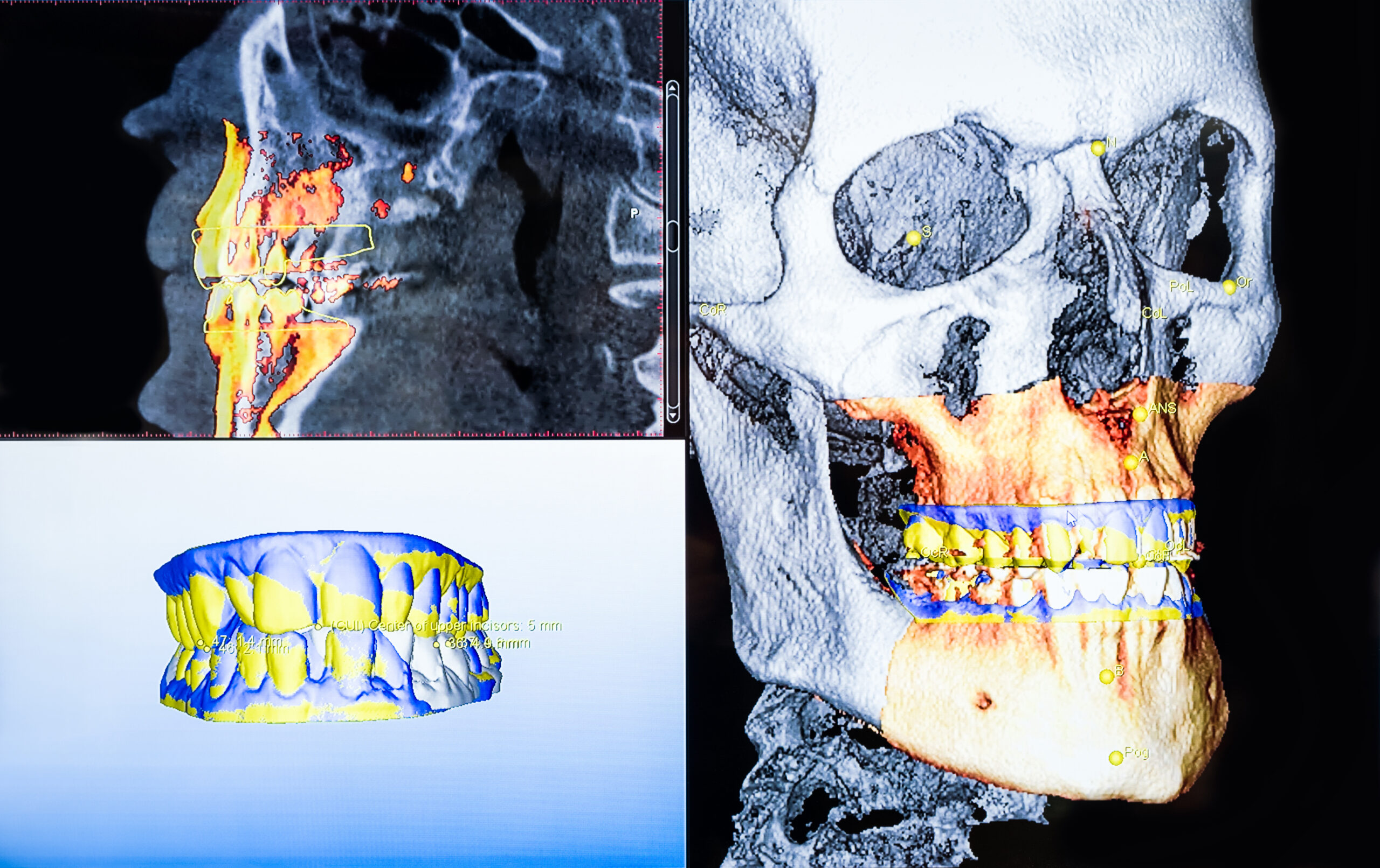How Bone Density Affects Your Eligibility For Dental Implants