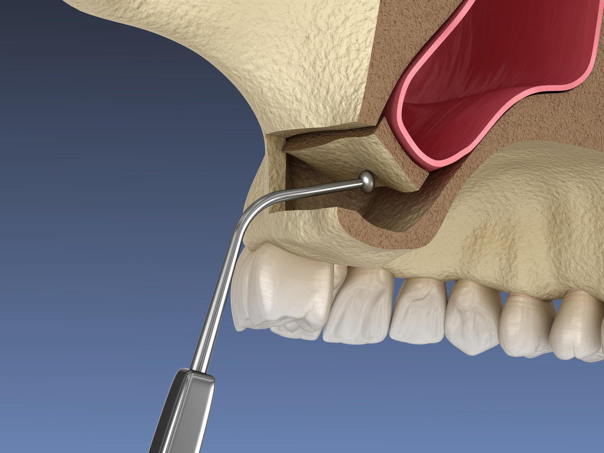 What Is A Sinus Lift And When Do I Need One For Dental Implants?