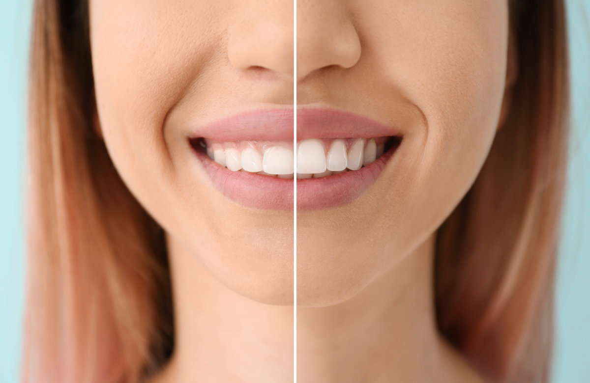 How Does Laser Gum Contouring Work For A Gummy Smile?