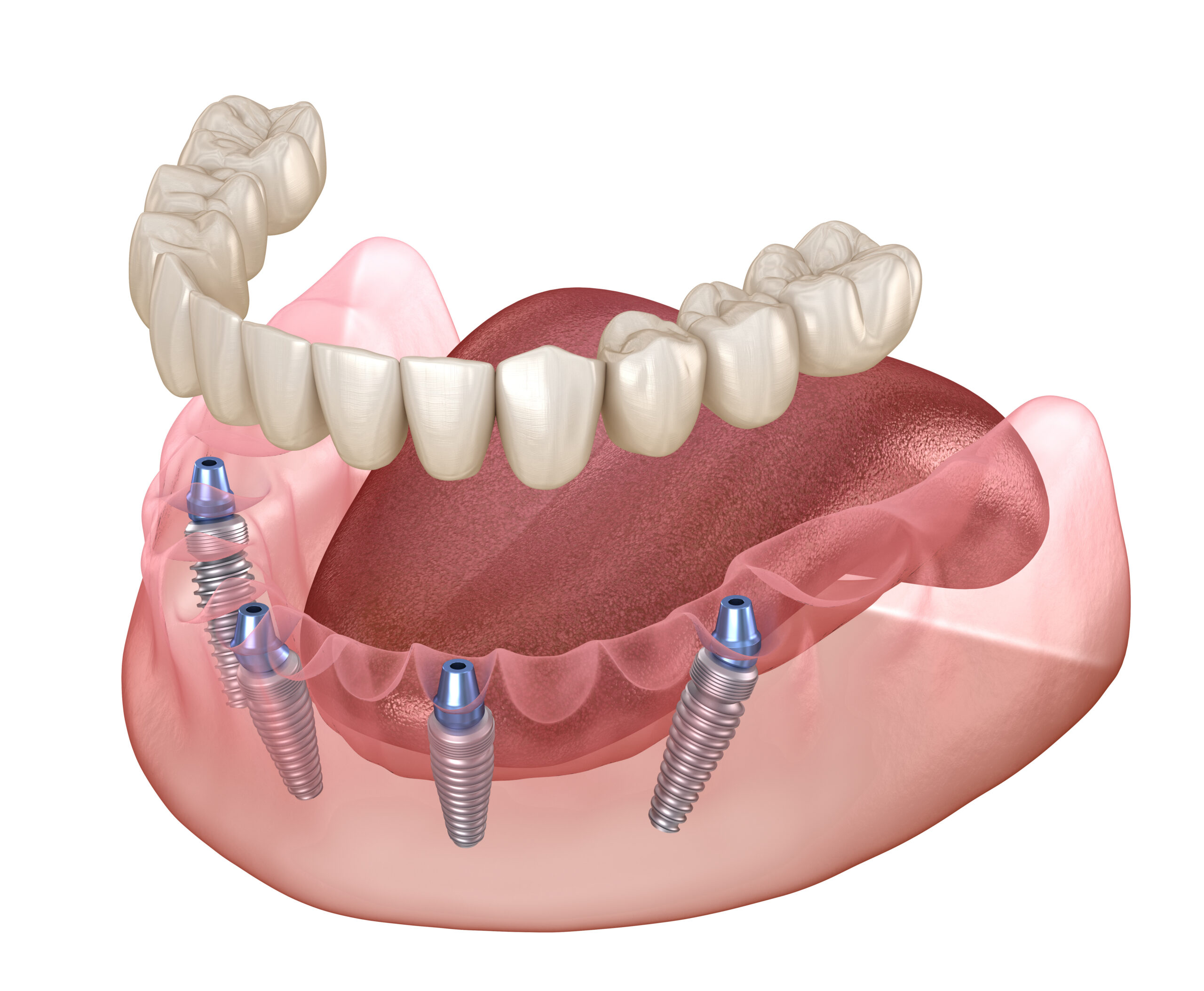 Can I Eat Normally After Getting All On Dental Implants?