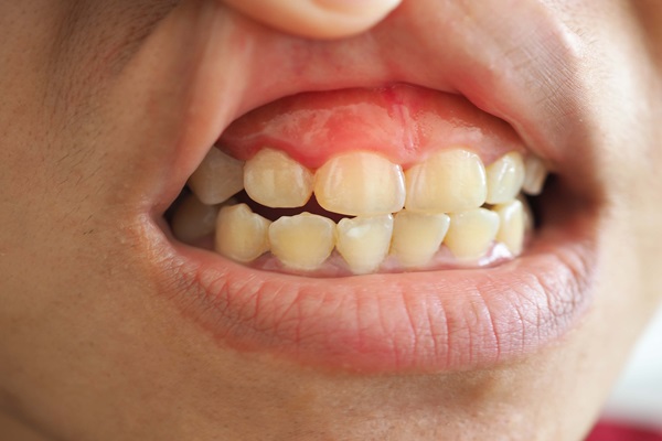 Signs And Symptoms Of Gum Disease