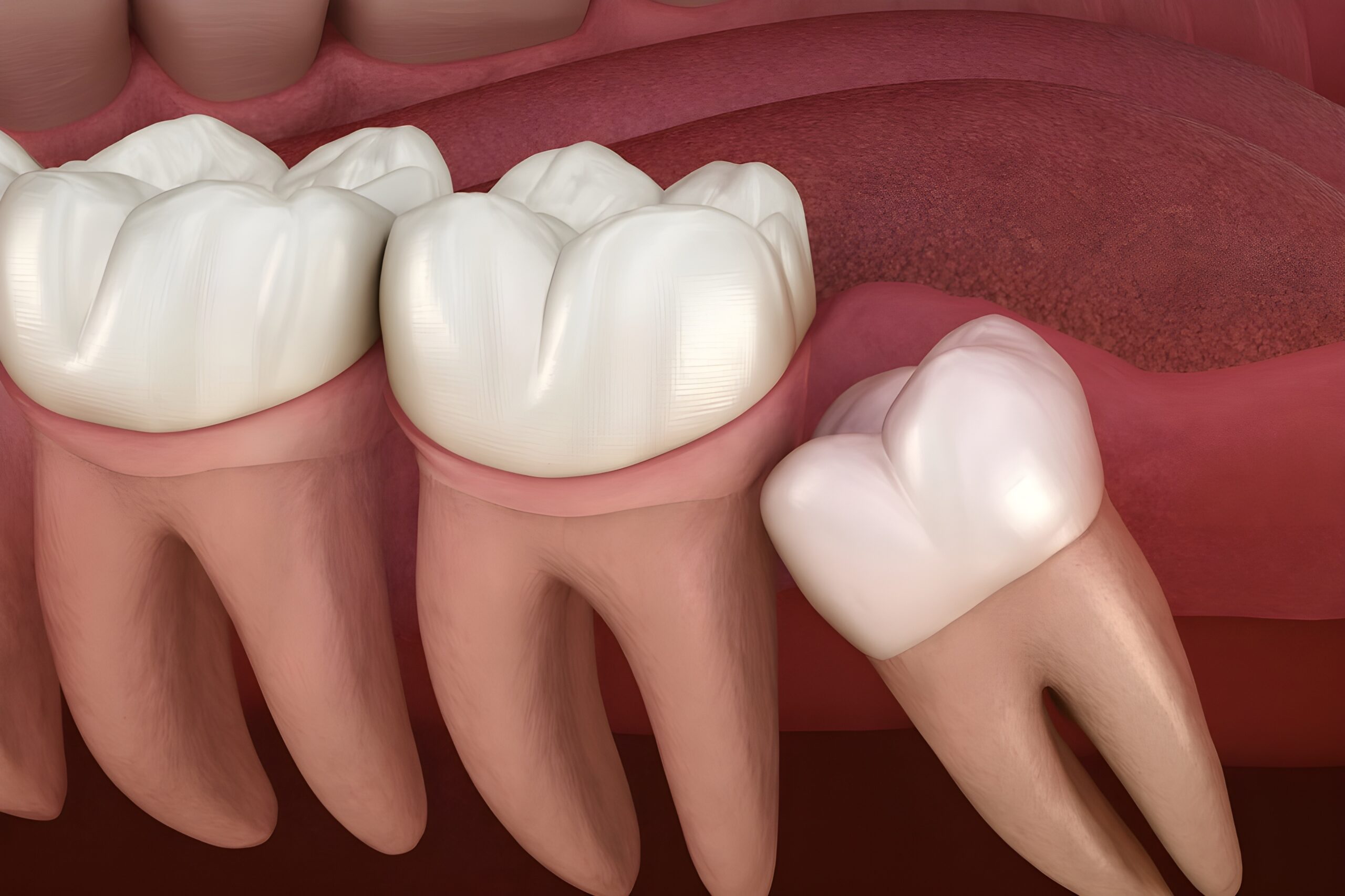 What Is The Recovery Time After Wisdom Teeth Removal?